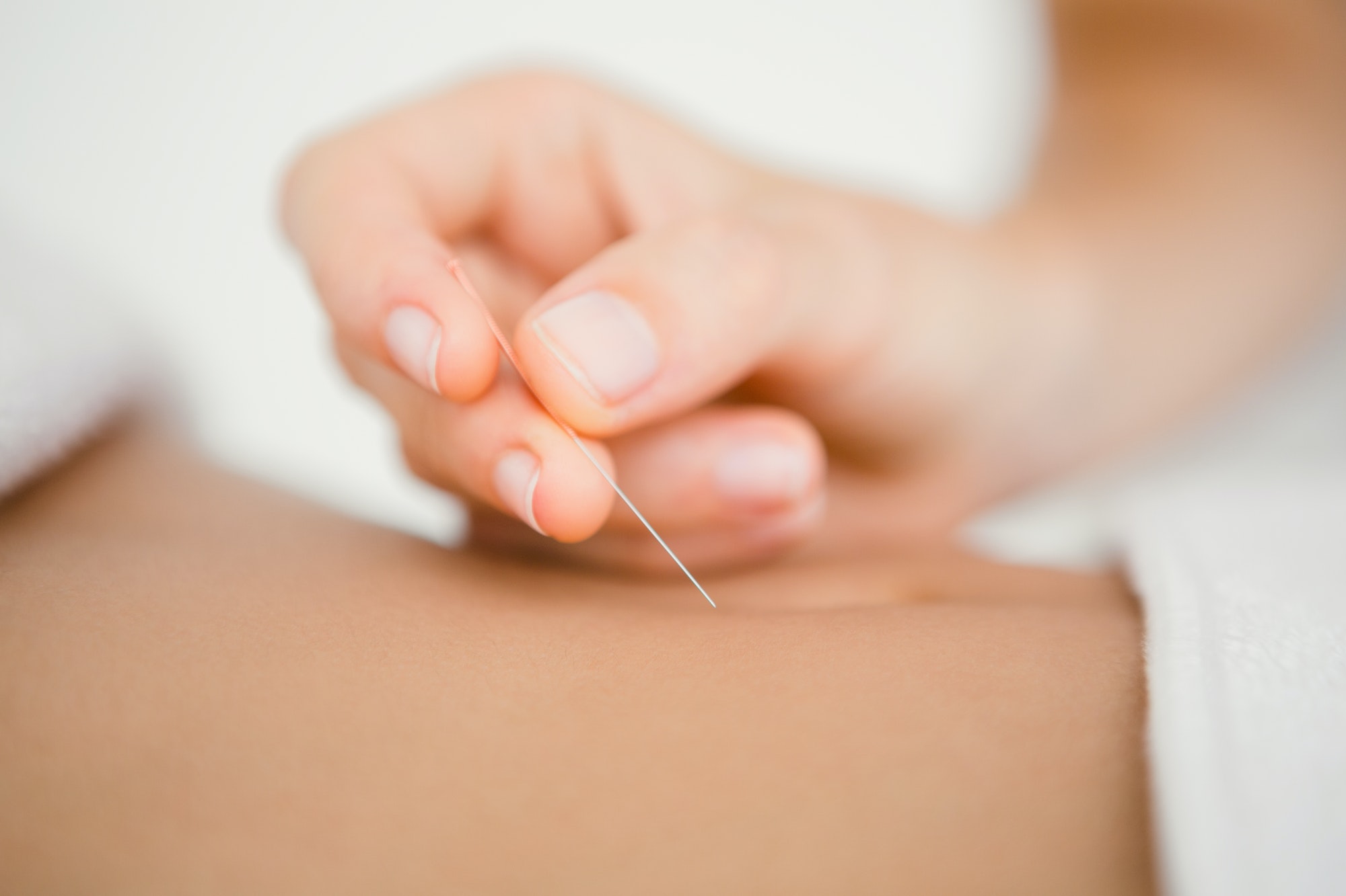 Terapia prin acupunctura